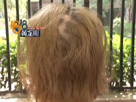 杭州1美女染完头发后头顶秃一大块医院诊断：斑秃