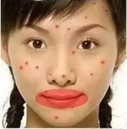 脸的侧面为什么长一些小痘痘,为什么额头上长了好多痘痘