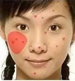 为什么长闭口粉刺痘痘还总是反复,痘痘反复长你知道是为什么吗