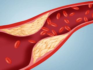 左侧股总动脉粥样斑块形成,吸烟造成动脉粥样斑块形成