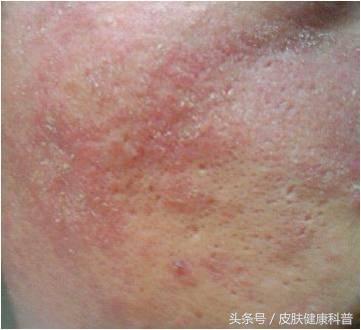 面部皮肤屏障受损要怎么修复,激素脸怎么修复皮肤屏障