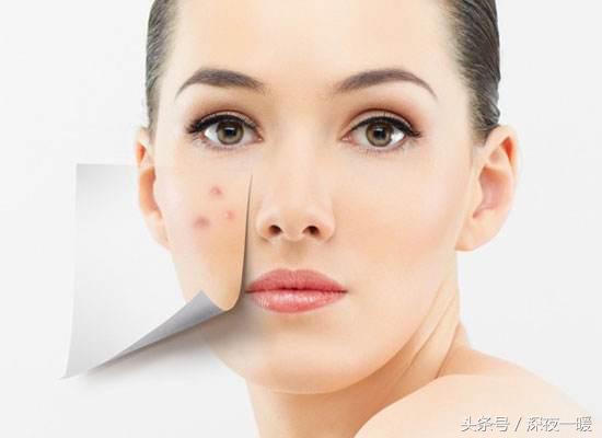 祛痘方法有哪些怎么祛痘最有效,祛痘怎么这么难啊