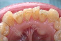 牙龈不增生的降压药,降压药引起的牙龈增生会好吗