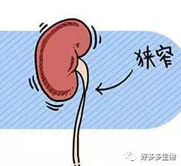 肾积水引发的尿漏怎么办,肾积水排尿困难吃什么药