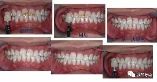 冷光美白牙齿靠谱吗,牙齿美白全过程视频