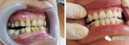 冷光美白牙齿靠谱吗,牙齿美白全过程视频