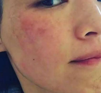 舒淇过敏修复方法,舒淇敏感肌自救方法