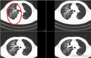 两年了老是咳嗽怎么回事,老人稍微活动气急气喘怎么办