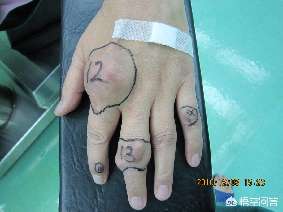 痛风石的治疗方案,痛风石怎么医治要做手术吗