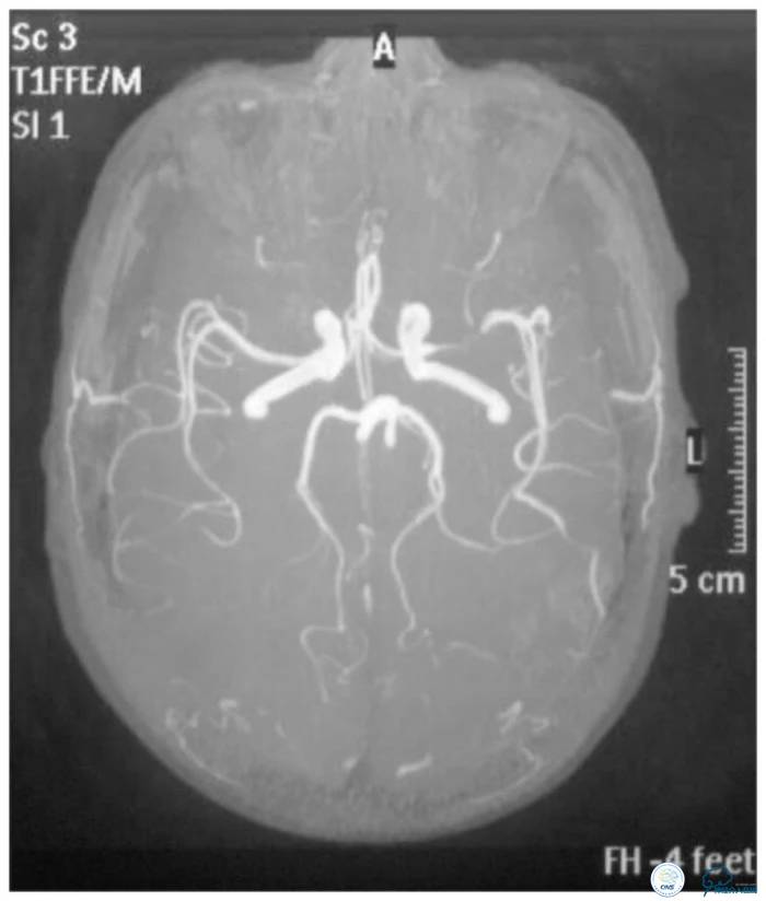 天坛医院脑梗支架,天坛医院做脑基底动脉支架