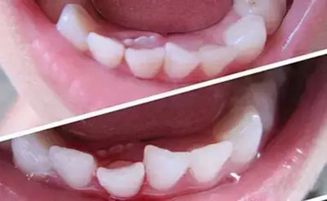 孩子长了两排门牙怎么回事,小孩长了两排牙怎么办需要矫正吗