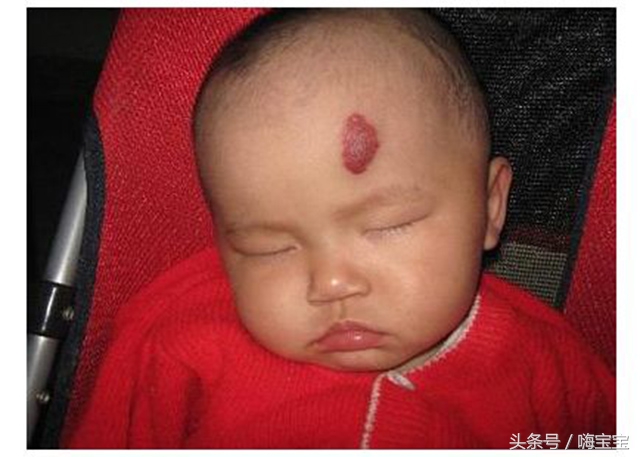 青色胎记会影响健康吗,小孩的胎记会影响身体吗