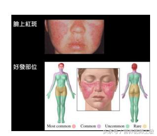 狼疮性肾炎生活及饮食宜忌,狼疮性肾炎患者日常生活注意事项