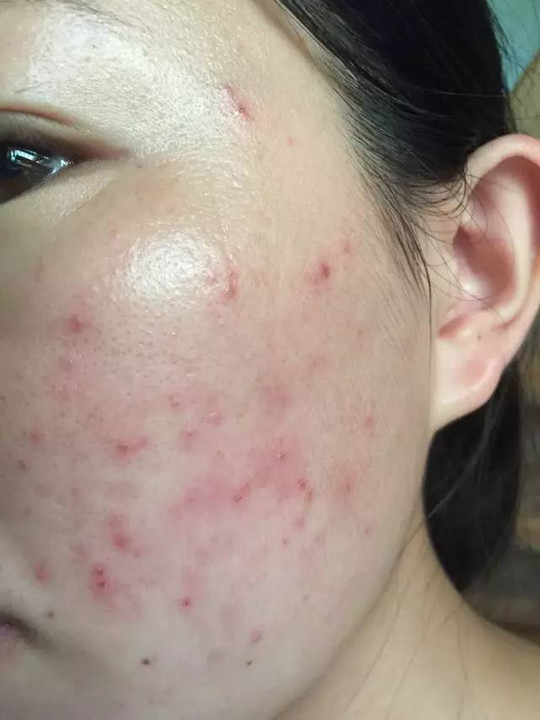 消了又长的疮是什么疮,脸部长疮的症状和治疗方法