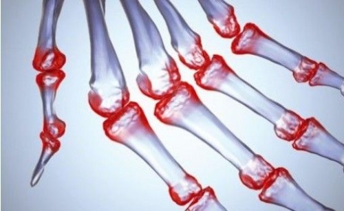 风湿全解｜夏季风湿关节炎危害大，如何有效治疗和预防？