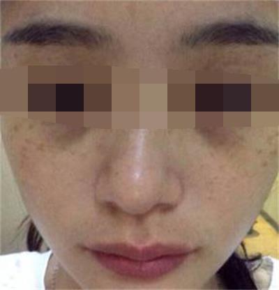 色素沉着怎么办,色素沉着该如何解决