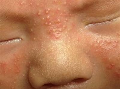 宝宝小红疙瘩怎么回事,宝宝小疙瘩