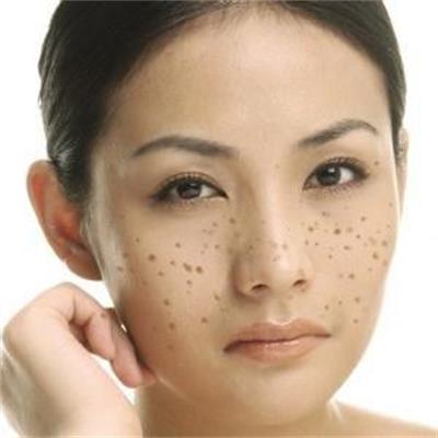 雀斑真的能激光祛除吗,光子祛斑和激光祛斑