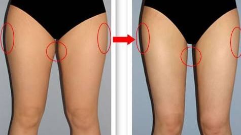 大腿抽脂后多久可以洗澡,大腿抽脂容易凹凸不平吗