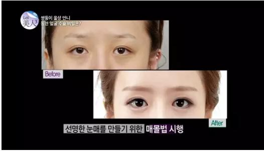 韩国整容手术恢复过程,韩国一个整容的综艺节目