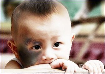 认识胎记,科普为什么很多婴儿有胎记