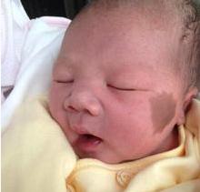 认识胎记,科普为什么很多婴儿有胎记