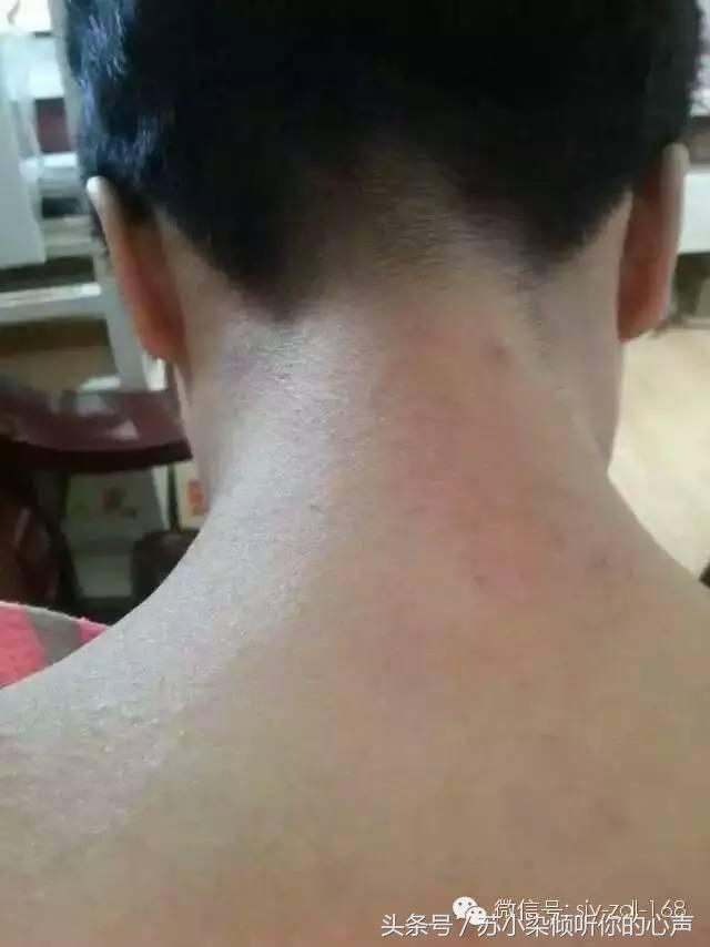 沙棘油，对皮肤还有如此神奇的效果