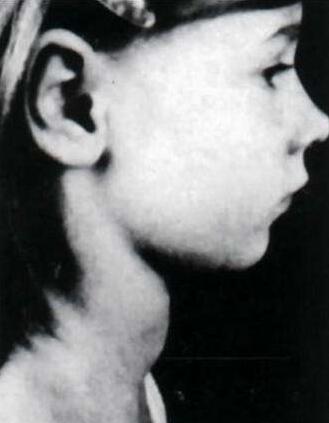 体检查出甲状腺结节情绪低落,公司体检甲状腺结节有影响吗