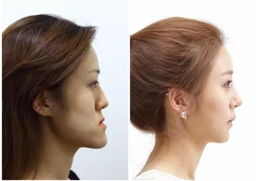 韩国整容手术恢复过程,韩国一个整容的综艺节目