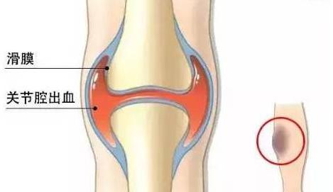 过敏性紫癜案例分享,过敏性紫癜的基本常识