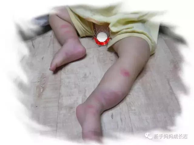 疱疹性荨麻疹怎么治丘疹性荨麻疹,荨麻疹儿科