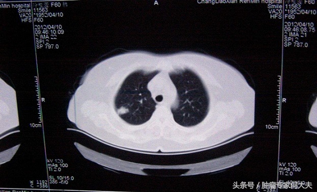 早期（I或II期）肺癌，究竟该如何治疗？