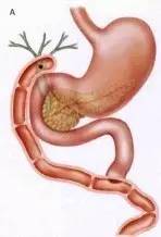 胃镜预处理流程,胃镜内镜手术全流程