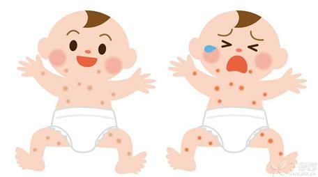 宝宝湿疹不要愁,快看皮肤科医生怎样治疗自家宝宝的湿疹?