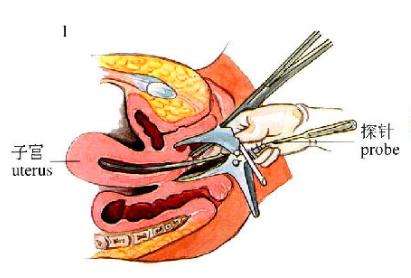 上环和取环的区别亲身经历,上环取环的相关知识