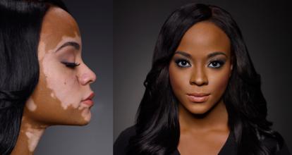 化妆品对白癜风有什么影响,白癜风用哪种化妆品比较好