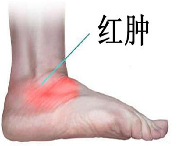 踝关节扭伤后热敷出现肿胀，疼痛加剧，怎样正确处理运动创伤呢