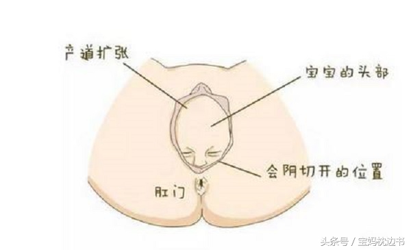 为什么医生不建议剖腹产顺产,宁可剖腹产也不用产钳