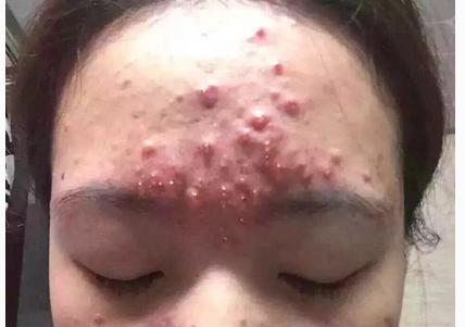 激素脸的症状和激素脸的治疗方法,到底什么是激素脸都有哪些症状