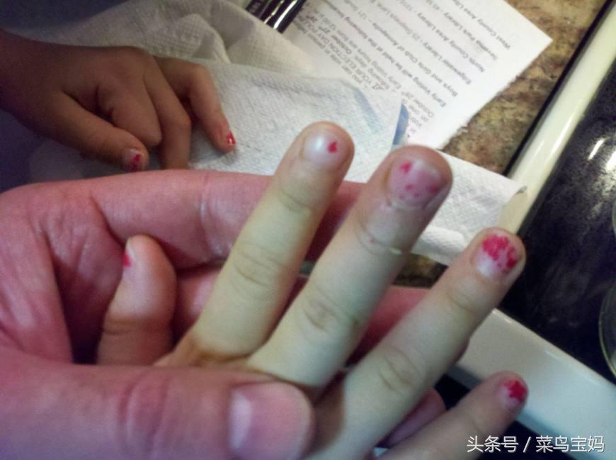 婴儿头部被产道夹伤有哪些损伤,婴儿被月嫂摔伤