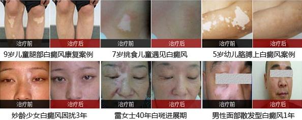 白斑病遗传到下一代吗,白斑病遗传几率有多大
