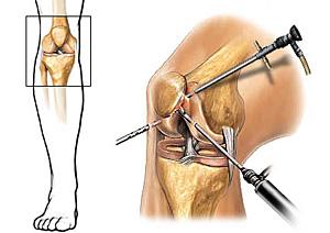 膝关节积液怎么处理最好,膝关节囊内少量积液