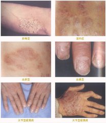 治疗牛皮癣的瑞典进口针剂,德国治牛皮癣最好的药