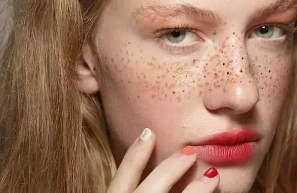 我满脸全是雀斑怎么办,满脸雀斑的我蜕变说说