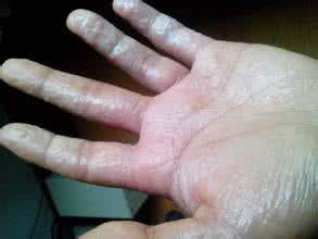 皮肤瘙痒脱皮是什么原因,双手瘙痒是什么原因引起的