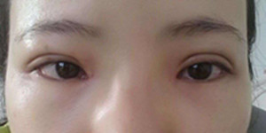 800的双眼皮和8000的双眼皮区别,五毛块钱的双眼皮