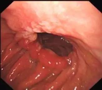 胃镜预处理流程,胃镜内镜手术全流程