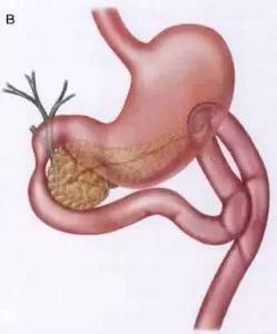 胃镜预处理流程,胃镜内镜手术全流程