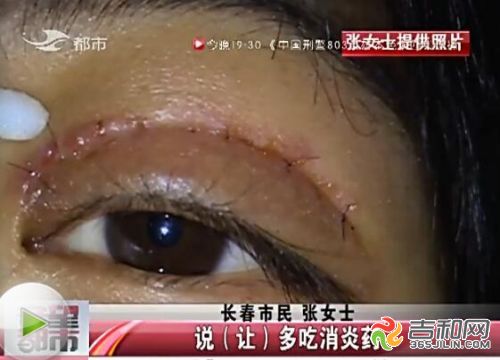长春市铭医整形美容医院双眼皮,长春铭医整形医院双眼皮案例