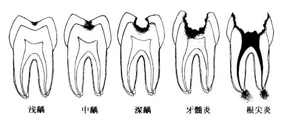 《奶酪陷阱》之我的“奶酪情”